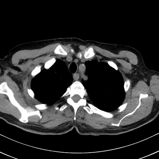 Aspergilloma on background pulmonary fibrosis (Radiopaedia 60942-68757 Axial non-contrast 13).jpg