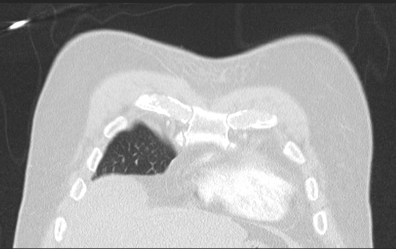 Aspirated tooth (Radiopaedia 28584-28844 Axial lung window 28).jpg