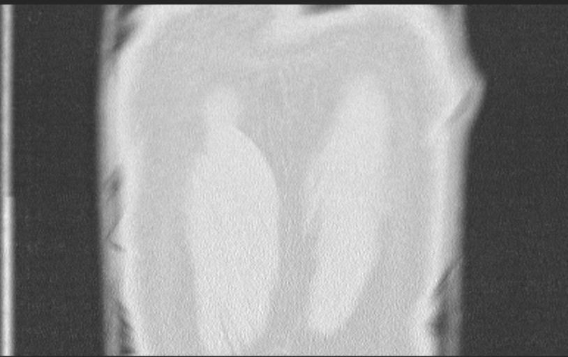 Aspirated tooth (Radiopaedia 28584-28844 Axial lung window 96).jpg