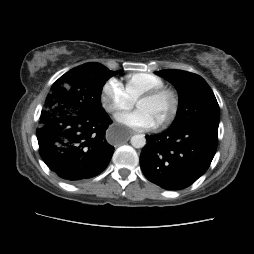 File:Aspiration pneumonia secondary to laparoscopic banding (Radiopaedia 18345-18183 A 33).jpg