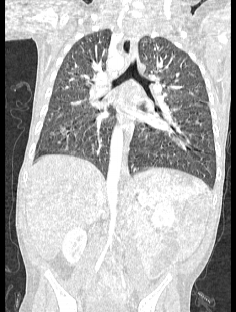 Asplenia syndrome (Radiopaedia 73083-83792 Coronal lung window 86).jpg