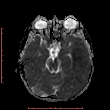 Astroblastoma (Radiopaedia 74287-85162 Axial ADC 21).jpg