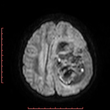Astroblastoma (Radiopaedia 74287-85162 Axial DWI 73).jpg