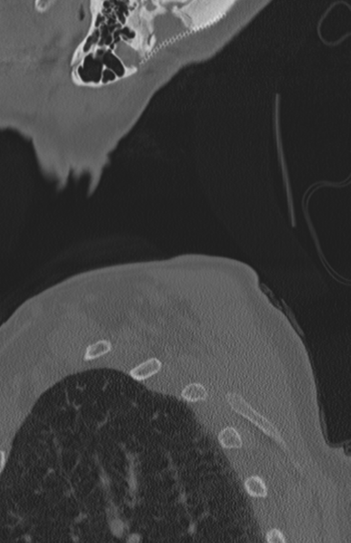 Atlanto-axial subluxation (Radiopaedia 36610-38176 Sagittal bone window 77).png