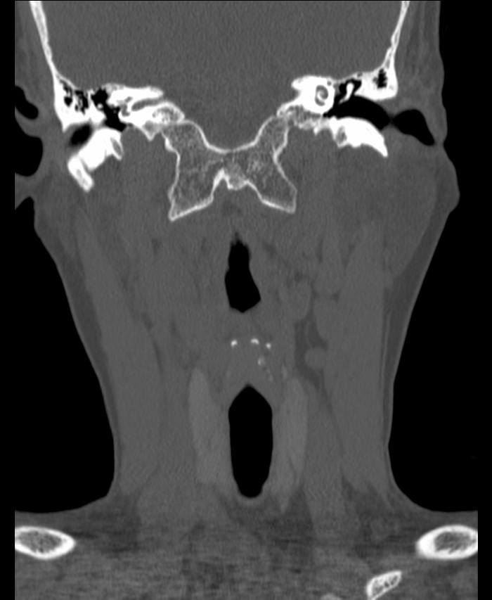 Atlanto-occipital assimilation with basilar invagination (Radiopaedia 70122-80188 Coronal bone window 45).jpg