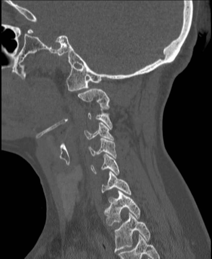 Atlanto-occipital assimilation with basilar invagination (Radiopaedia 70122-80188 Sagittal bone window 112).jpg