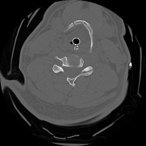 Atlanto-occipital dissociation injury (Radiopaedia 29274-29698 Axial bone window 44).png