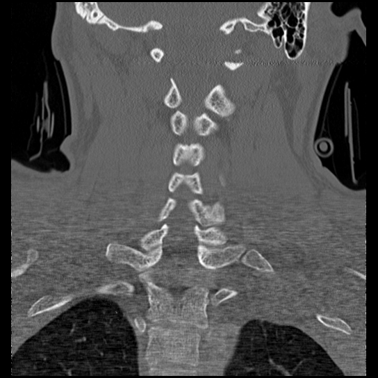 Atlanto-occipital dissociation injury (Radiopaedia 29274-29698 Coronal bone window 18).png