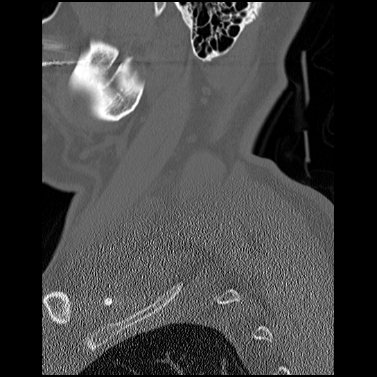 Atlanto-occipital dissociation injury (Radiopaedia 29274-29698 Sagittal bone window 3).png