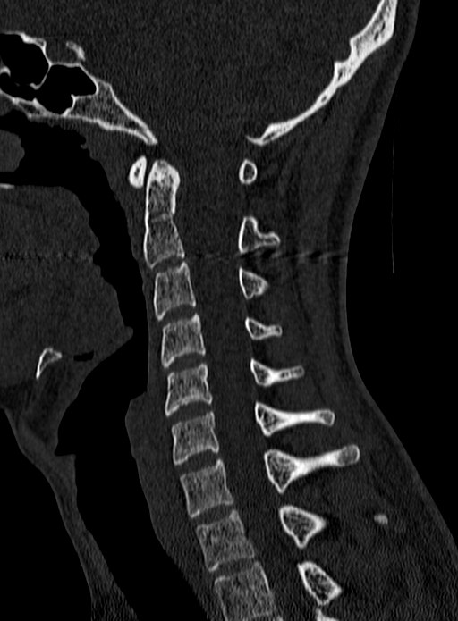 Atlantoaxial subluxation (Radiopaedia 44681-48450 Sagittal bone window 71).jpg