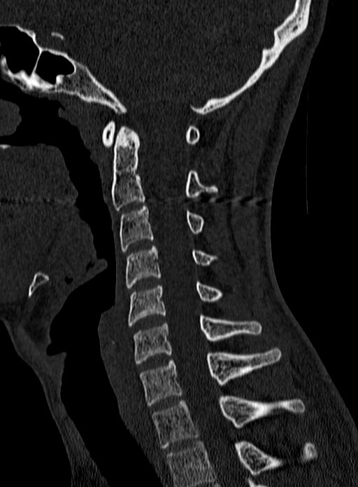 Atlantoaxial subluxation (Radiopaedia 44681-48450 Sagittal bone window 75).jpg