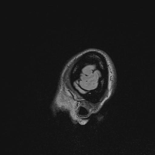 Atretic encephalocoele with inferior vermis hypoplasia (Radiopaedia 30443-31108 Sagittal FLAIR 144).jpg