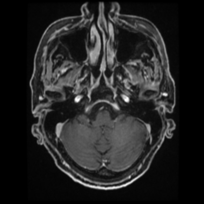 Atypical meningioma (Radiopaedia 45535-49629 Axial T1 C+ 22).jpg