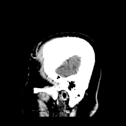 Atypical meningioma (WHO grade II) with brain invasion (Radiopaedia 57767-64728 Sagittal C+ 48).png