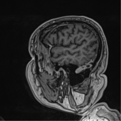 File:Atypical meningioma (WHO grade II) with brain invasion (Radiopaedia 57767-64729 Sagittal T1 C+ 18).png