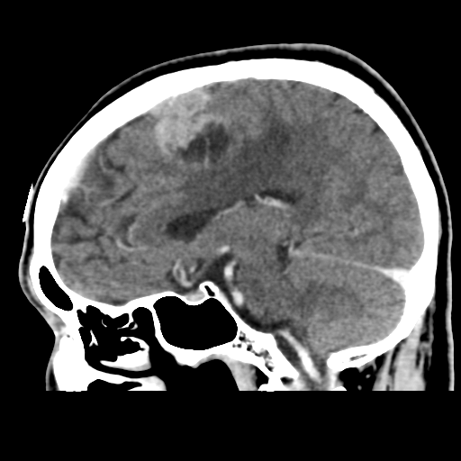 File:Atypical meningioma (WHO grade II) with osseous invasion (Radiopaedia 53654-59715 G 25).png
