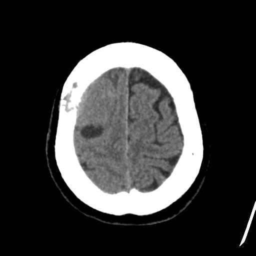 Atypical meningioma with skull invasion (Radiopaedia 34357-35649 Axial non-contrast 45).png