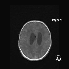 File:Atypical teratoid rhabdoid tumor (prenatal US and neonatal MRI) (Radiopaedia 59091-66388 Axial T1 42).jpg