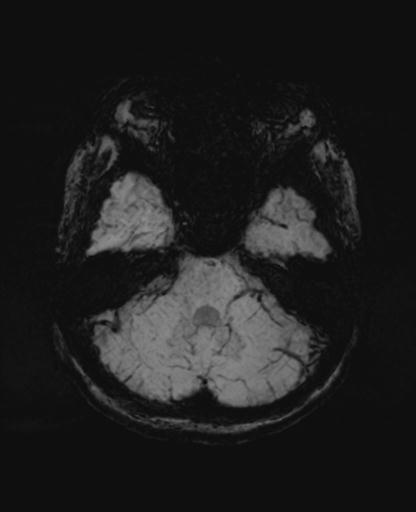 Autoimmune limbic encephalitis (Radiopaedia 30363-31005 SWI - mIP 18).jpg