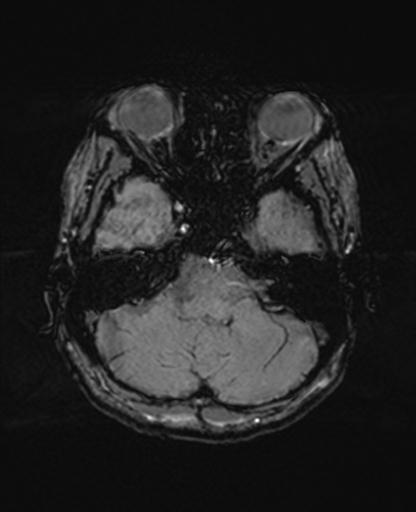 Autoimmune limbic encephalitis (Radiopaedia 30363-31005 SWI 17).jpg
