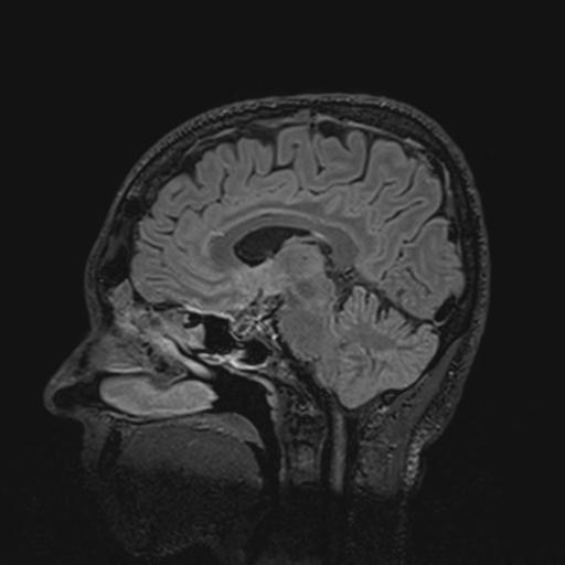 Autoimmune limbic encephalitis (Radiopaedia 30363-31005 Sagittal FLAIR 75).jpg