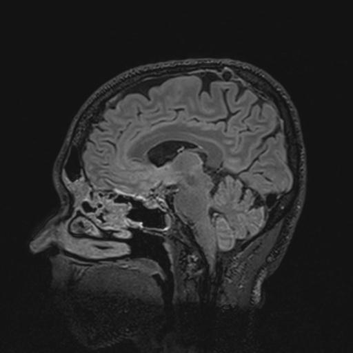 Autoimmune limbic encephalitis (Radiopaedia 30363-31005 Sagittal FLAIR 86).jpg
