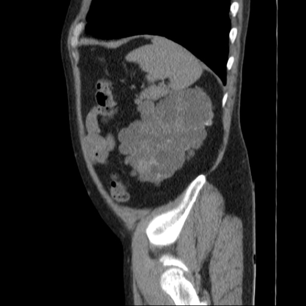 Autosomal dominant polycystic kidney disease (Radiopaedia 36539-38101 D 68).jpg