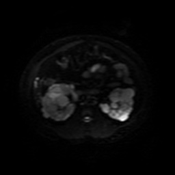 Autosomal dominant polycystic kidney disease (Radiopaedia 50259-55611 Axial DWI 23).jpg