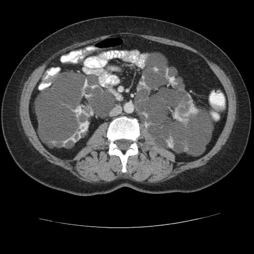 Autosomal dominant polycystic kidney disease with hepatic involvement (Radiopaedia 32693-33662 B 40).jpg