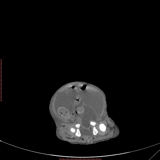 File:Autosomal recessive polycystic kidney disease associated with Caroli disease (Radiopaedia 61932-69984 B 335).jpg
