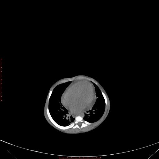 Autosomal recessive polycystic kidney disease associated with Caroli disease (Radiopaedia 61932-69984 B 78).jpg