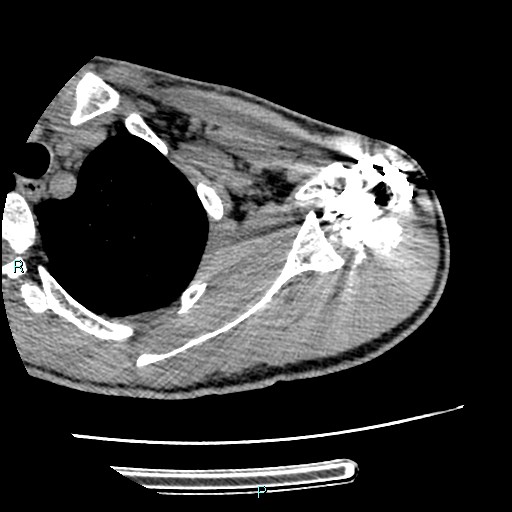 Avascular necrosis after fracture dislocations of the proximal humerus (Radiopaedia 88078-104655 D 49).jpg
