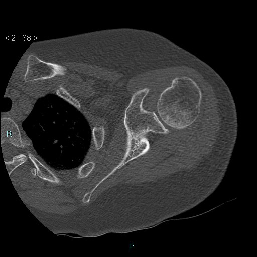 Avascular necrosis of the shoulder - Cruess stage I (Radiopaedia 77674-89887 Axial bone window 22).jpg