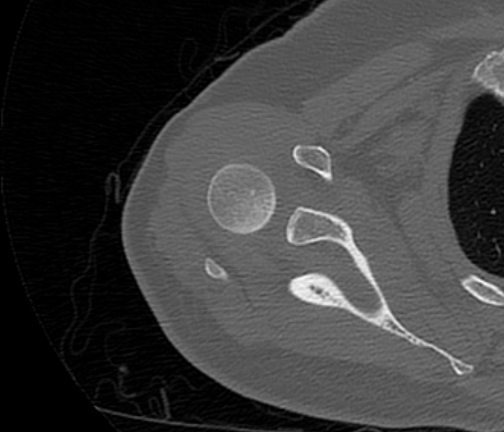 Avulsion fracture - greater tuberosity of humerus (Radiopaedia 71216-81514 Axial bone window 28).jpg