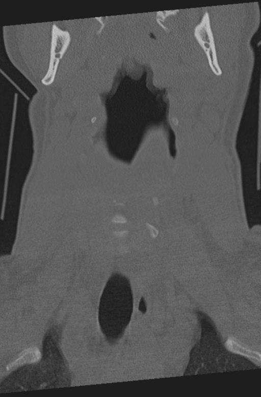 Axis peg fracture (type 3) and atlas lateral mass (type 4) fracture (Radiopaedia 37474-39324 Coronal bone window 6).png