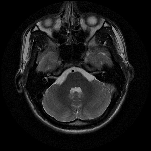 File:Azygos anterior cerebral artery (Radiopaedia 17059-16756 Axial T2 19).jpg