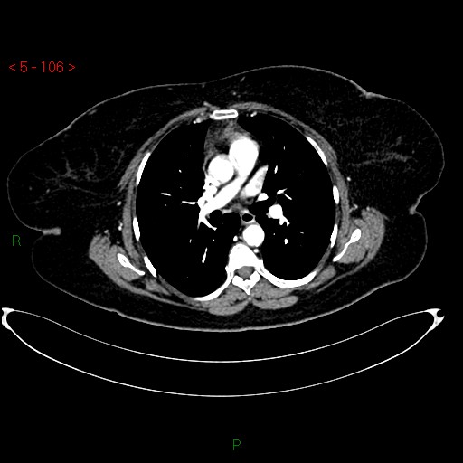 Azygos fissure and lobe (Radiopaedia 47620-52278 A 92).jpg