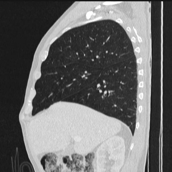 Azygos lobe (Radiopaedia 38259-40275 lung window 31).jpg