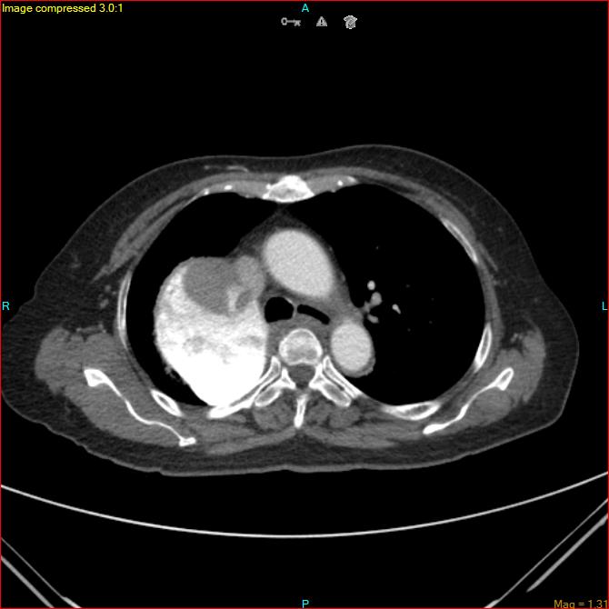 Azygos vein aneurysm (Radiopaedia 77824-90130 B 22).jpg