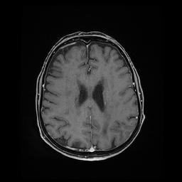 Balo concentric sclerosis (Radiopaedia 53875-59982 Axial LAVA C+ 173).jpg