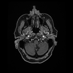 Balo concentric sclerosis (Radiopaedia 53875-59982 Axial LAVA C+ 36).jpg