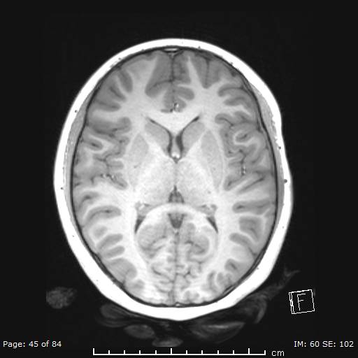 Balo concentric sclerosis (Radiopaedia 61637-69636 Axial T1 45).jpg