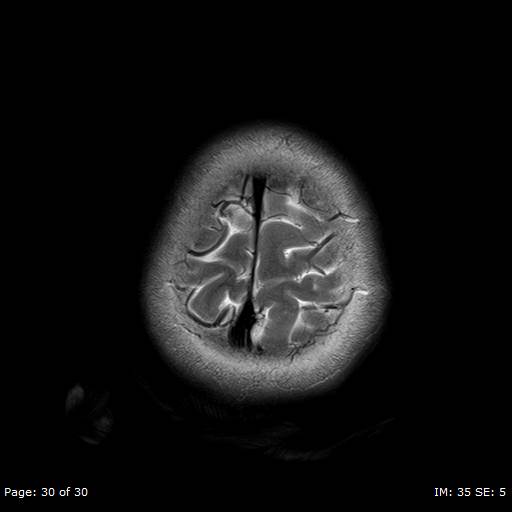 File:Balo concentric sclerosis (Radiopaedia 61637-69636 Axial T2 30).jpg