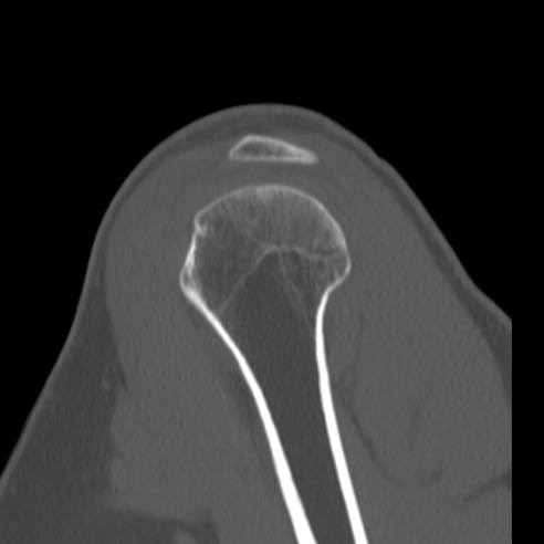 Bankart lesion (Radiopaedia 57256-64185 Sagittal bone window 15).jpg