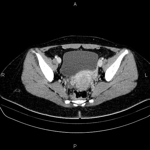 File:Bartholin gland cyst (Radiopaedia 62635-70930 Axial Post contrast 46).jpg
