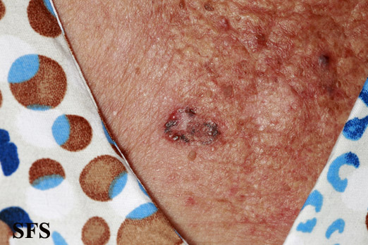 Basal Cell Carcinoma (Dermatology Atlas 257).jpg