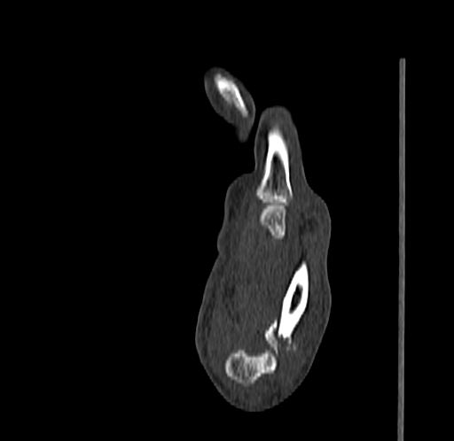 Base of 2nd metacarpal fracture (Radiopaedia 73741-84544 Sagittal bone window 62).jpg