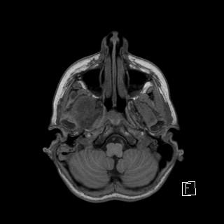 Base of skull rhabdomyosarcoma (Radiopaedia 32196-33142 Axial T1 7).jpg