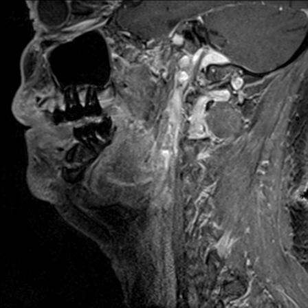 Base of tongue squamous cell carcinoma (Radiopaedia 31174-31884 F 121).jpg