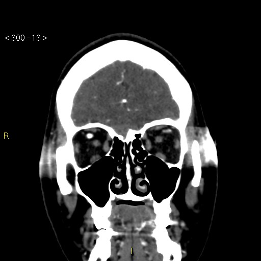 File:Basilar artery thrombosis (Radiopaedia 16260-15944 B 4).jpg